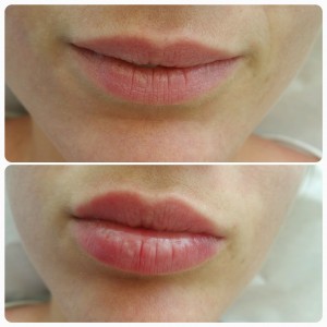 Lip Fillers Glasgow - before & after